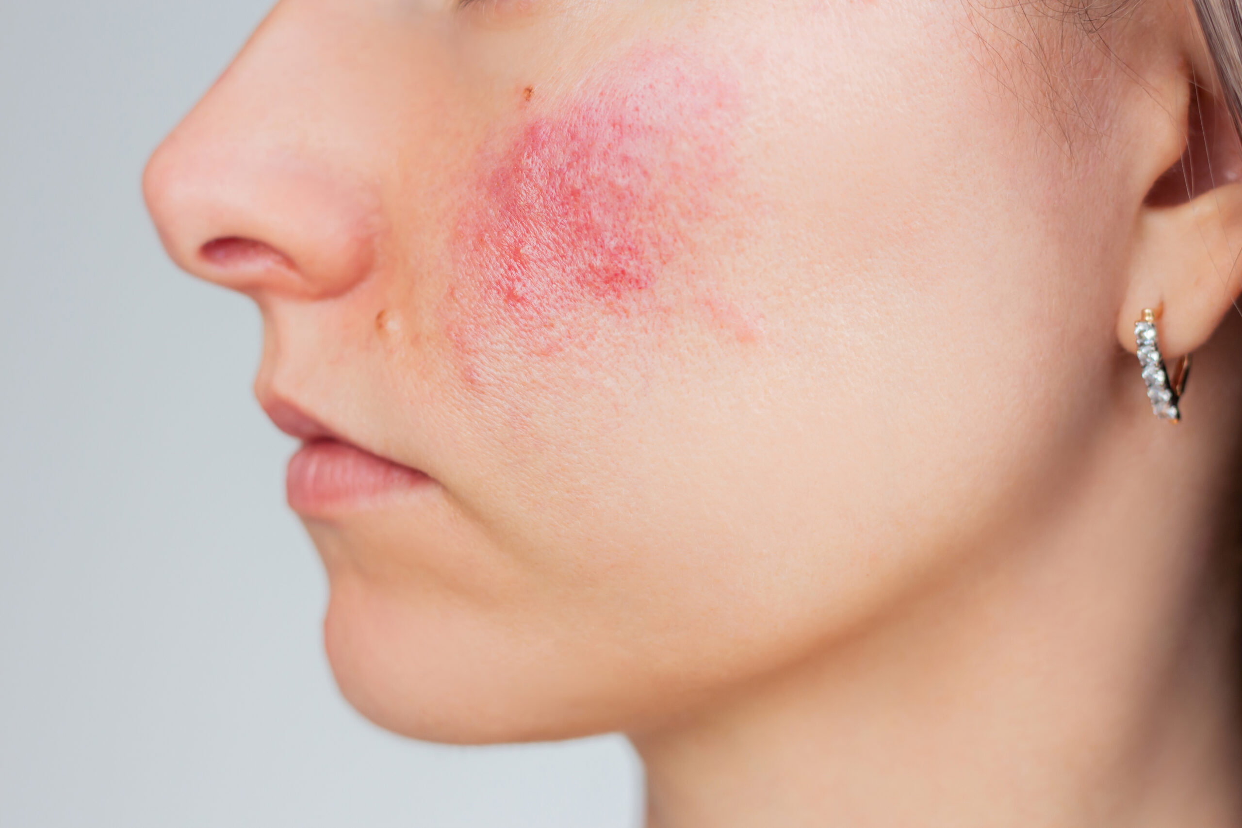 Roodheid gezicht verminderen